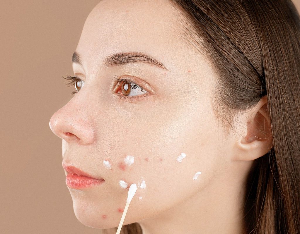A woman putting a treatment on her acne.