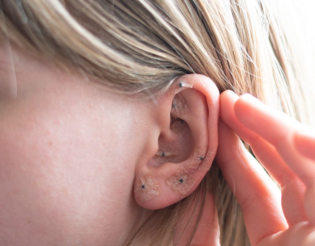 a woman with blonde hair displaying acupuncture ear seeds