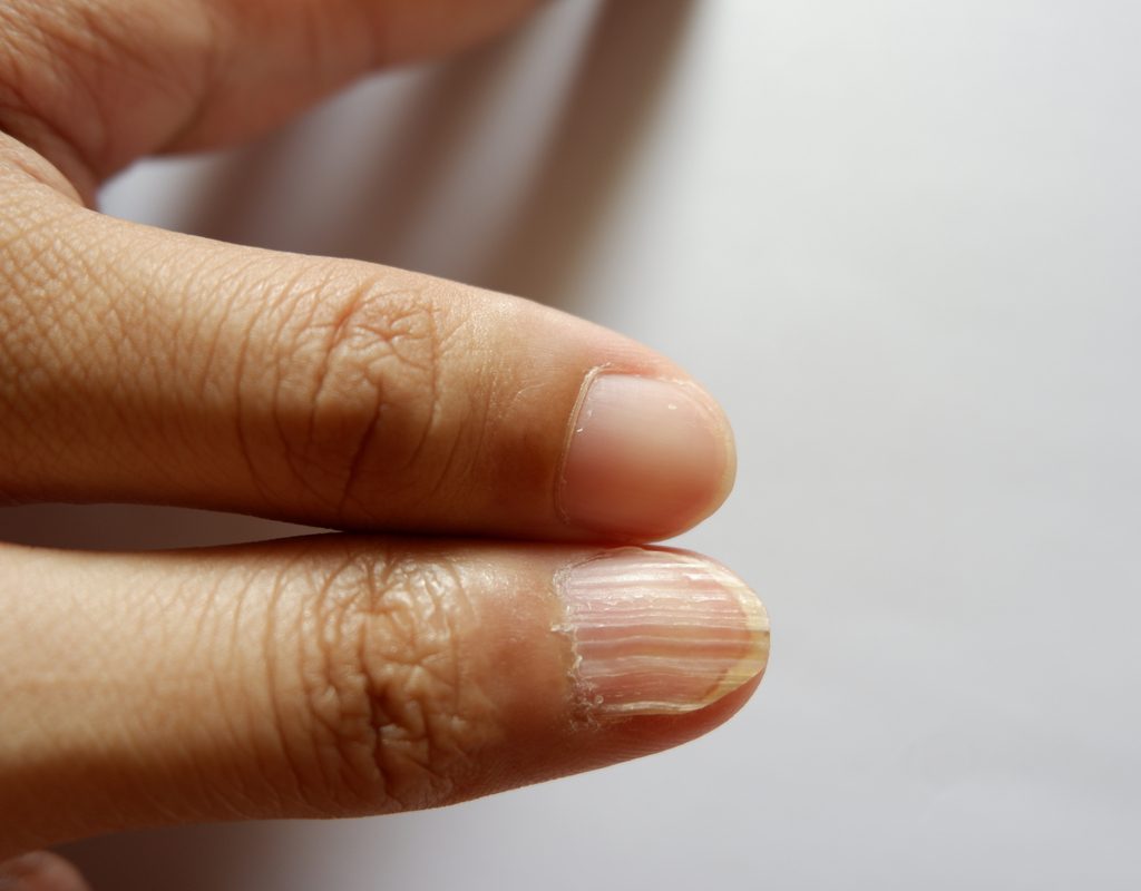 Brittle nails iron deficiency