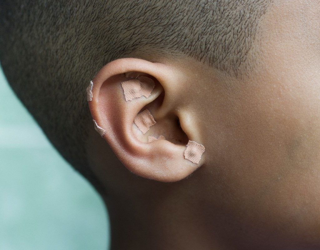 woman with acupuncture ear seeds in. the adhesive is still on the seed.