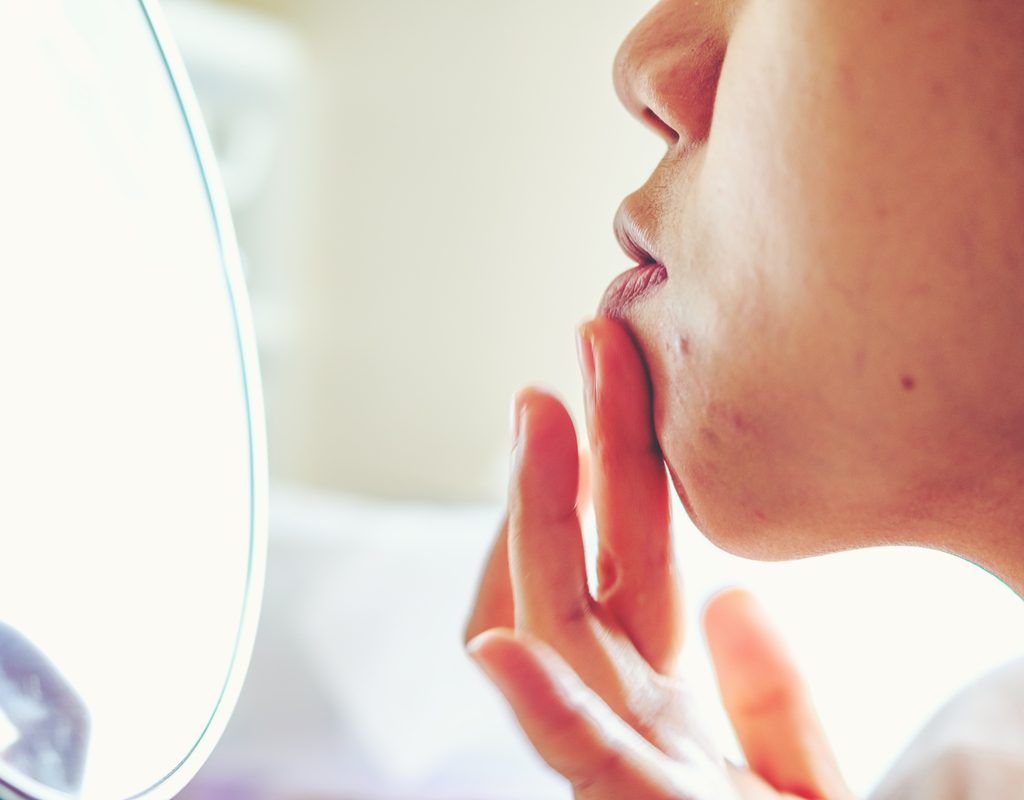 A woman looking at the bumps along her chin.
