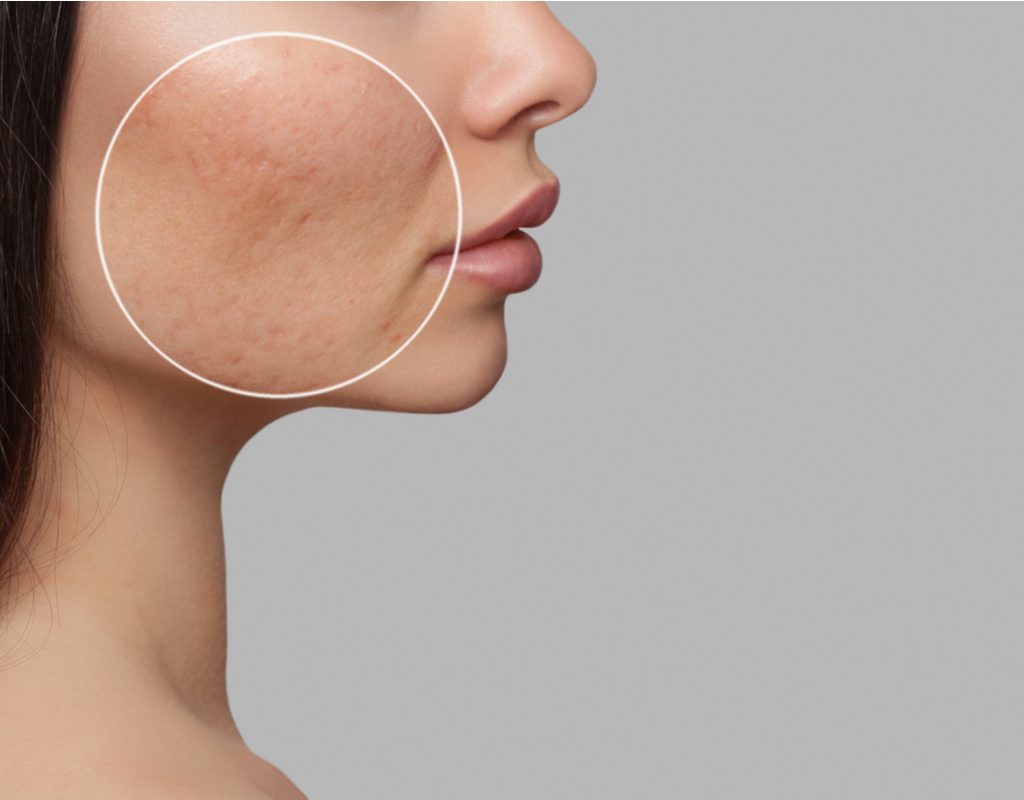 A woman with some acne scarring and discoloration on her cheek.