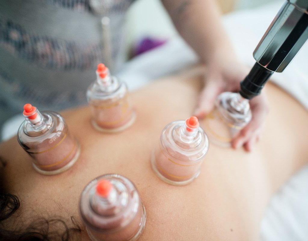 woman lying down receiving cupping therapy