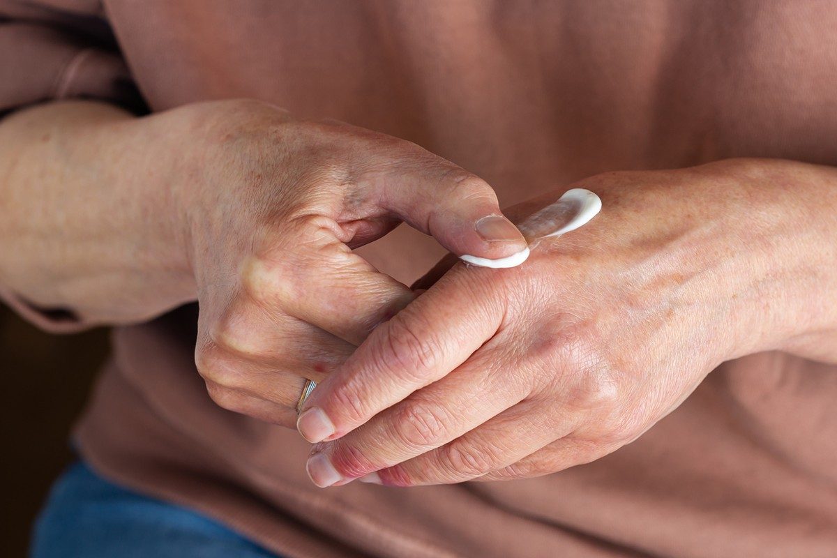 Finding the best eczema lotion for dry skin