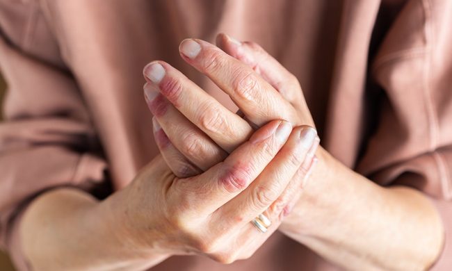 woman applying the best eczema lotion on dry skin