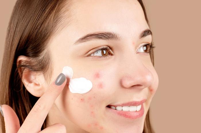 A woman with acne applying a cream to her face.