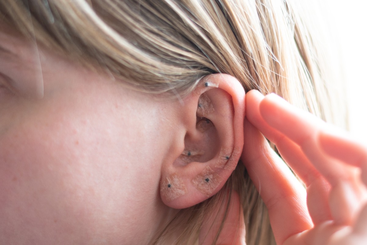 Why Acupuncture Ear Seeds Might Help Relieve Your Anxiety BlissMark