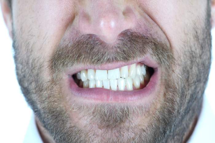 teeth grinding mouth guards angrymangrindingteethcloseup 1024x1024