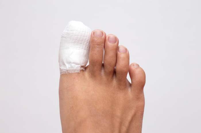 toenail ingrown infection treatment ingrowntoenailhealingbyremovedsomenailb