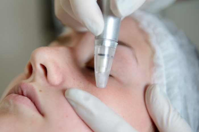 person receiving microdermabrasion procedure