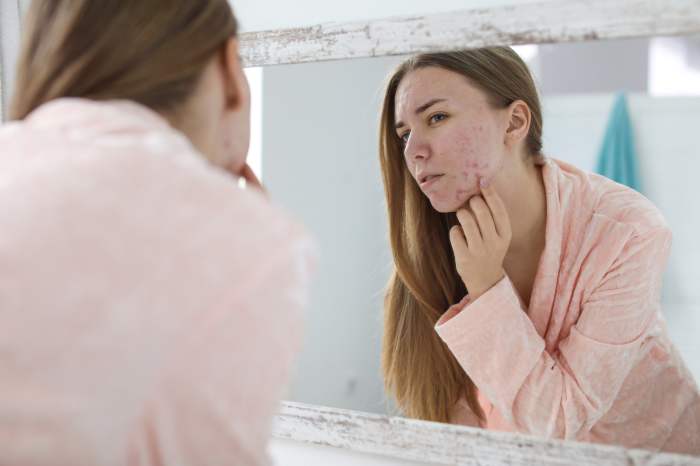 sleep acne connection young woman problem