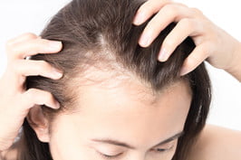 female pattern baldness treatment womanserioushairlossproblemforhealthcareshampooand 266x266