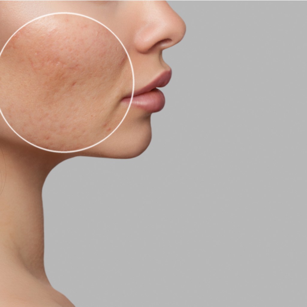 A woman with some acne scarring and discoloration on her cheek.