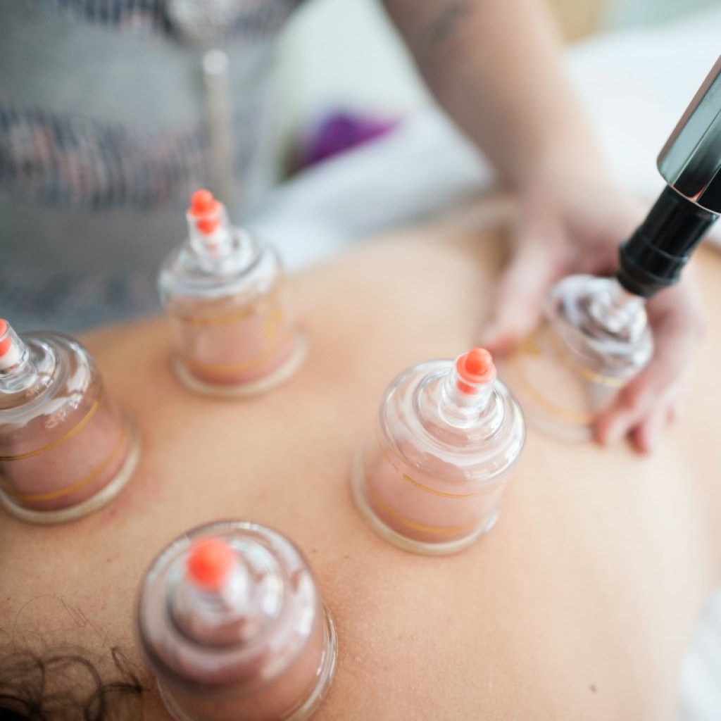 woman lying down receiving cupping therapy