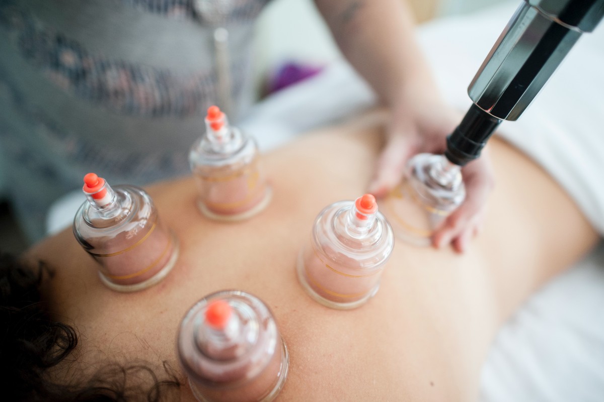 woman lying down receiving cupping therapy