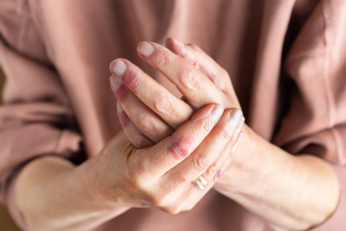 woman applying the best eczema lotion on dry skin